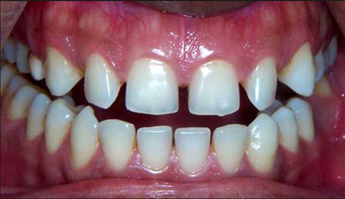 010315111117SpacesBetweenTeeth